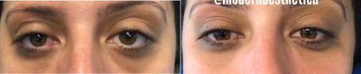 Voluma before and after photo