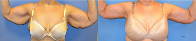 Arm Lift before and after photo