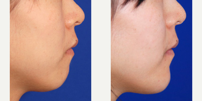 Chin Implant before and after photo