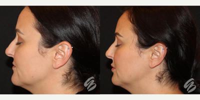 Juvederm before and after photo