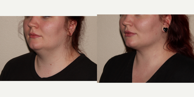 Renuvion before and after photo