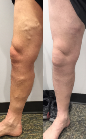 Sclerotherapy before and after photo