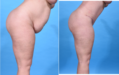 Tummy Tuck before and after photo