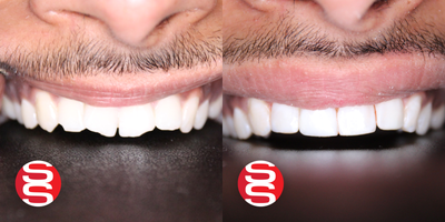 Dental Bonding before and after photo