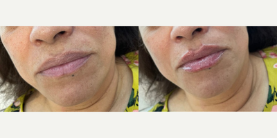 Dermal Fillers before and after photo