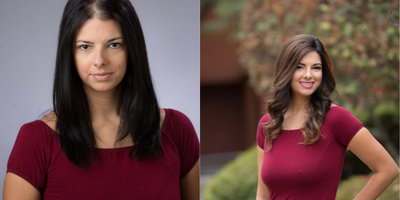 Hair Loss Treatment before and after photo