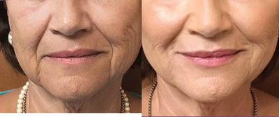 Juvederm before and after photo