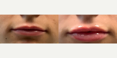 Lip Fillers before and after photo