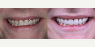 Smile Makeover before and after photo