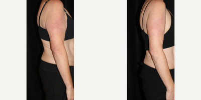 Arm Lift before and after photo