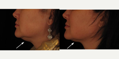 Dermal Fillers before and after photo
