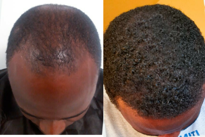 Hair Loss Treatment before and after photo