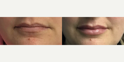 Restylane Defyne before and after photo