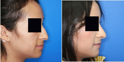 Rhinoplasty before and after photo