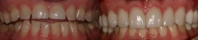 Smile Makeover before and after photo