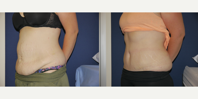 Tummy Tuck before and after photo