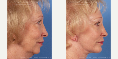 Chin Implant before and after photo