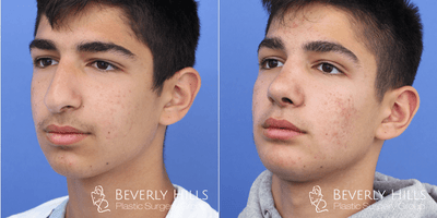 Chin Implant before and after photo