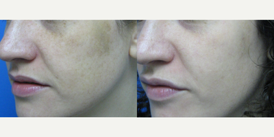 Photodynamic Therapy before and after photo