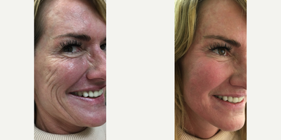 Radiesse before and after photo