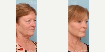 Eyelid Surgery before and after photo