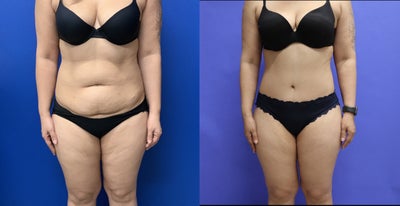 Tummy Tuck before and after photo