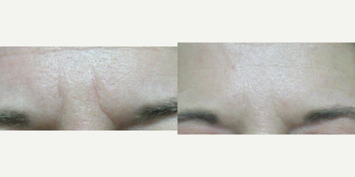 Botox before and after photo