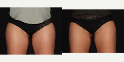 CoolSculpting before and after photo
