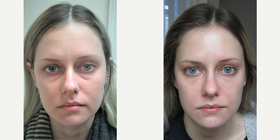 Dermal Fillers before and after photo