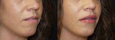 Lip Fillers before and after photo