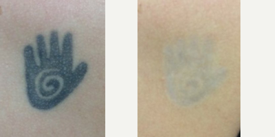 Tattoo Removal before and after photo