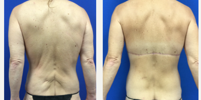 Back Lift before and after photo