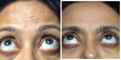 Dermal Fillers before and after photo