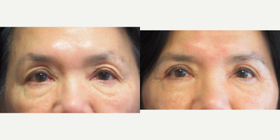 Eyelid Surgery before and after photo