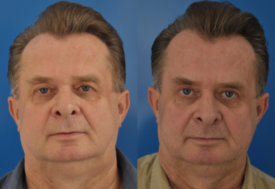 Eyelid Surgery before and after photo