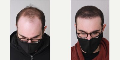 FUE Hair Transplant before and after photo
