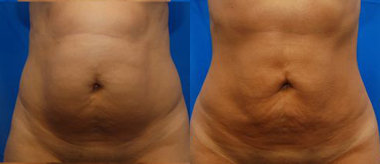 Liposuction before and after photo
