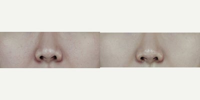 Potenza before and after photo