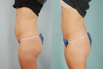 Smart Lipo before and after photo