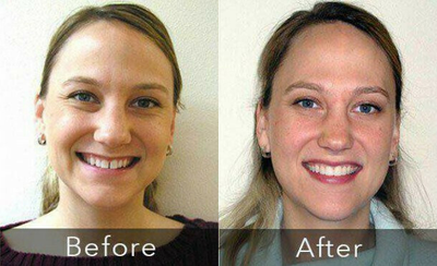 Smile Makeover before and after photo