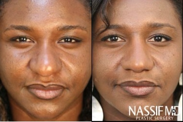 African American Rhinoplasty before and after photo