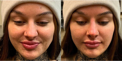 Dermal Fillers before and after photo