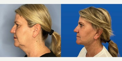 Facelift before and after photo