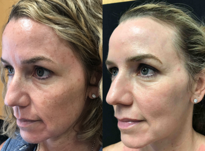 Fraxel Laser before and after photo