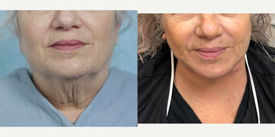 Neck Lift before and after photo