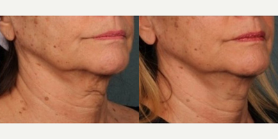 Sofwave before and after photo