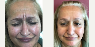 Botox before and after photo