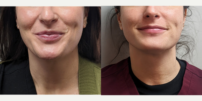 Botox before and after photo