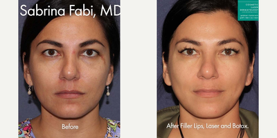 Botox before and after photo