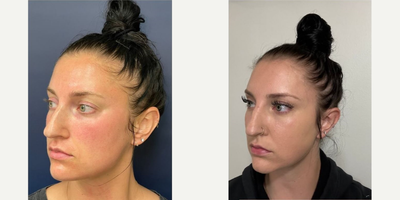 Dermal Fillers before and after photo